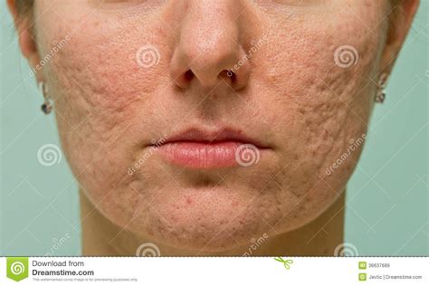 Problematic Skin Royalty Free Stock Images Image 36637689
