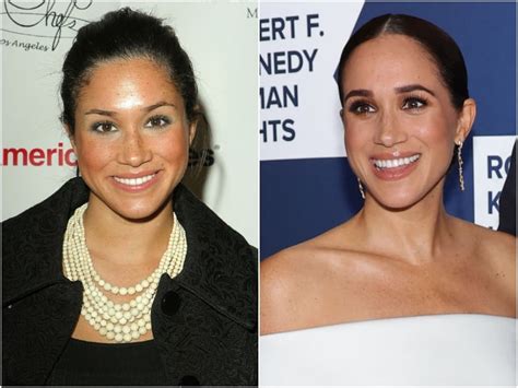 Amazing Celebrity Dental Transformations Million Dollar Smiles That