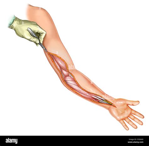 Compartment Syndrome Arm Hi Res Stock Photography And Images Alamy