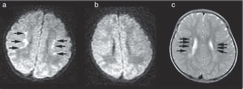 Punctate White Matter Lesions In A Late Preterm‐born Infant With