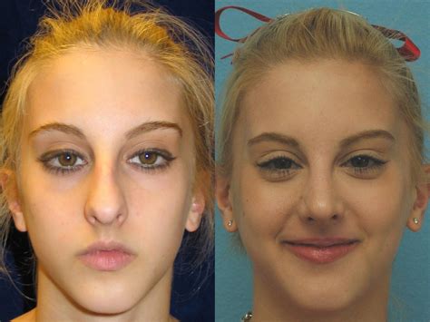 Facial Implants Before And After Photo Gallery San Francisco Ca
