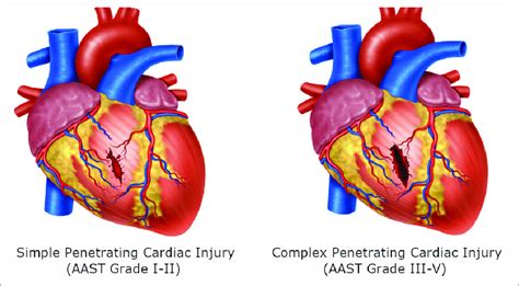 Cardiac Injuries A Cardiac Injury Of The Ventricle With Perilesional