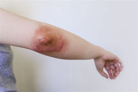 Eczema On Elbows