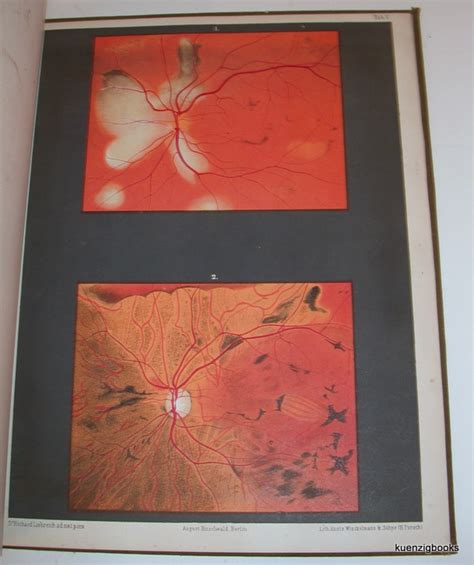 Atlas Of Ophthalmoscopy Representing The Normal And Pathological