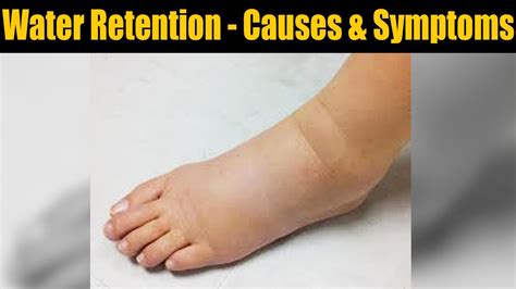 Water Retention Causes And Symptoms Check Out Here Boldsky Youtube