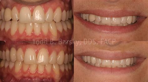 Dental Implants Archives Todd B Barsky Dds
