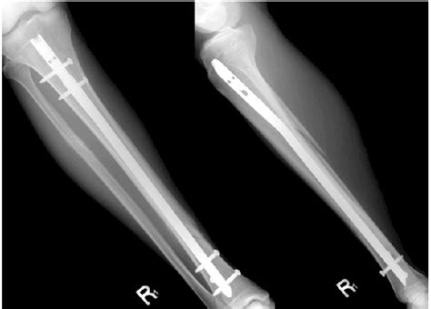 Postoperative Anteroposterior And Lateral Radiographs Of The Tibia