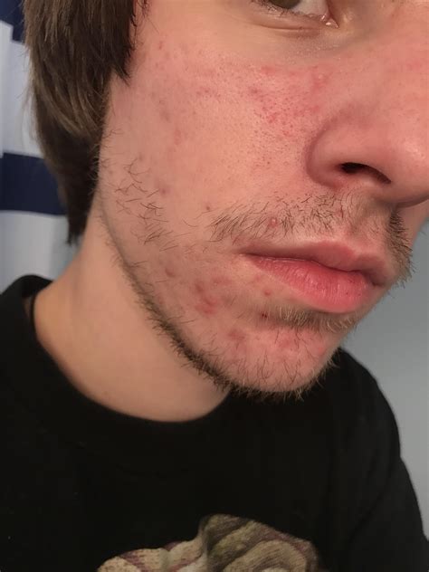 Redness All Over My Face Not Really Sure What To Do General Acne