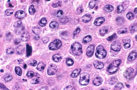 Diffuse Large B Cell Lymphomas