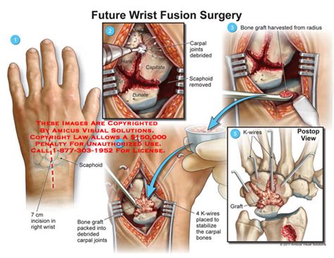 Amicus Illustration Of Amicus Surgery Wrist Future Fusion Scaphoid Carpal Joints Debrided Hamate