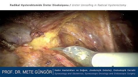 Radikal Histerektomide Üreter Diseksiyonu - Ureter ...