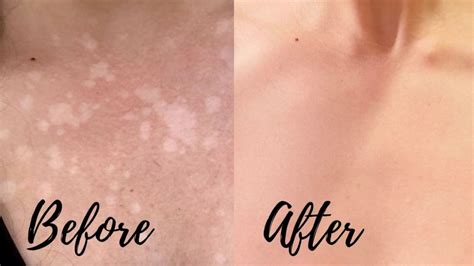 My At Home Tinea Versicolor Cure Fast Results Radiantly Nourished