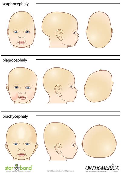 Kiddie Cranials Prosthetic Orthotic Designs