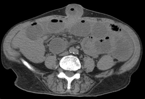 Incarcerated Umbilical Hernia In A Patient With Cirrhosis Eurorad