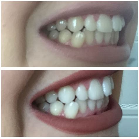My Teeth Whitening Transformation Before And After Sleek Chic