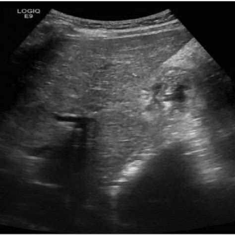 Ultrasound Of Right Upper Quadrant Showing Solid And Cystic Mass In The