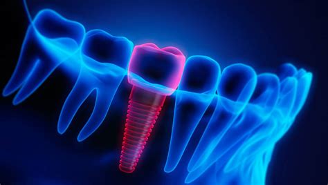 What Are The Signs Of Dental Implant Failure Dental Blog