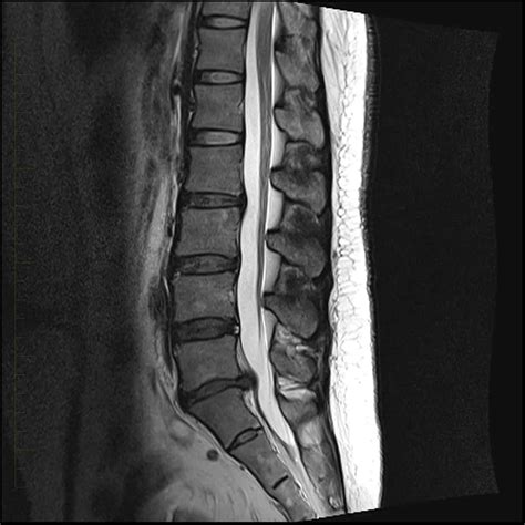 Mri Of The Lower Back Diagnostic Imaging Melbourne Radiology