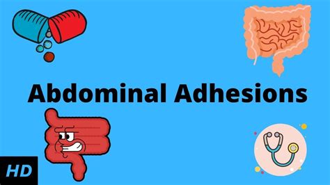 Abdominal Adhesions Causes Signs And Symptoms Diagnosis And