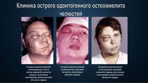 Что такое остеомиелит челюсти Картинка - Что такое остеомиелит челюсти