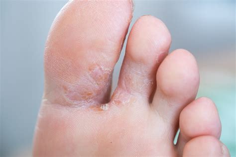 Athletes Foot What Is It And How To Prevent It