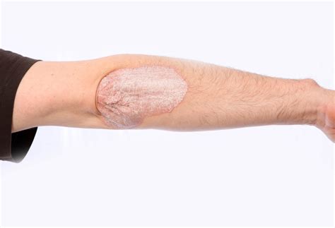 Tips For Treating Eczema In The Winter Short Hills Dermatology