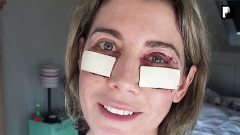 Blepharoplasty Video Diary Day 2 After Surgery 2 Of 15 Youtube