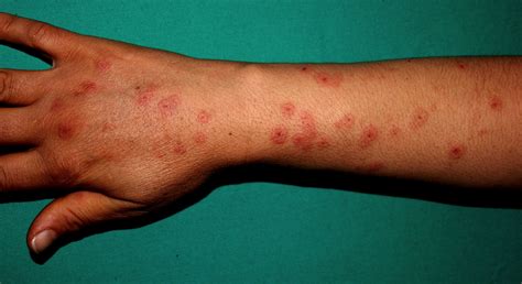dermatomyositis-hands-dermatomyositis-hands-hands,-children-images,-image