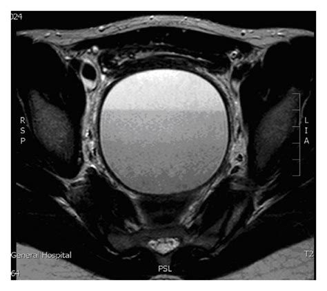 Ultrasound Scan Showing Fluid Filled Uterus Download Scientific Diagram