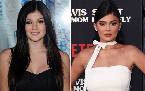 Kylie Jenner Prima E Dopo La Chirurgia Ecco Come è Cambiata La Sorella