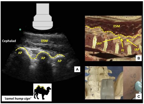 Ultrasound Guided Lumbar Central Neuraxial Blockade