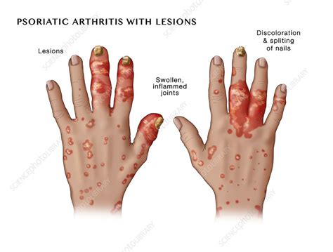 Psoriatic Arthritis With Lesions Stock Image C0365704 Science