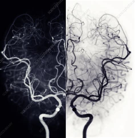 Cerebral Arteries Angiogram Stock Image F0377061 Science Photo