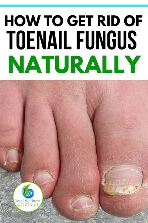 Looking For How To Get Rid Of Toenail Fungus Fast And Naturally Here