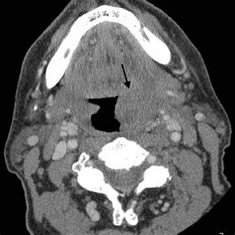 Initial Ct Scan With Iv Contrast Of Left Palatine Tonsillar Mass Before