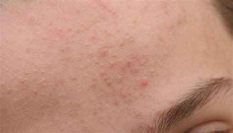 How To Identify And Treat Fungal Acne Health And Wellness Blog