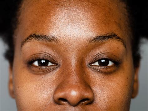 Hyperpigmentation On Black Skin