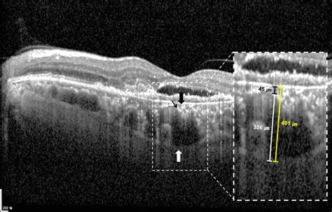 Measurement Of Subfoveal Choroidal Thickness Sfct And The Thickness