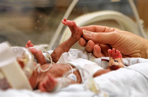 Most Premature Babies Are Growing Up Healthy Despite Odds Ny Daily News