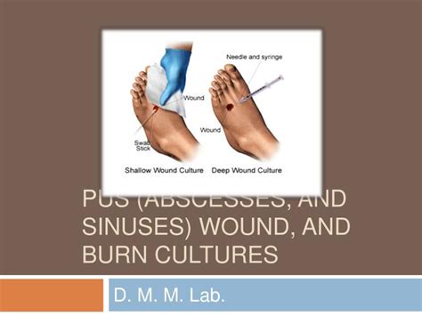 Ppt Pus Abscesses And Sinuses Wound And Burn Cultures Powerpoint
