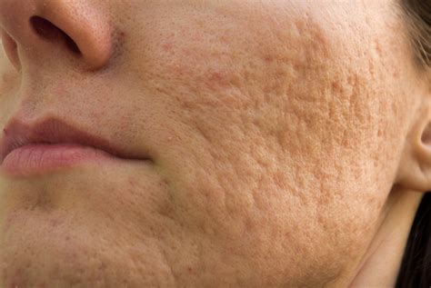 Clear Acne Scars Fast And Simple With The Best Methods