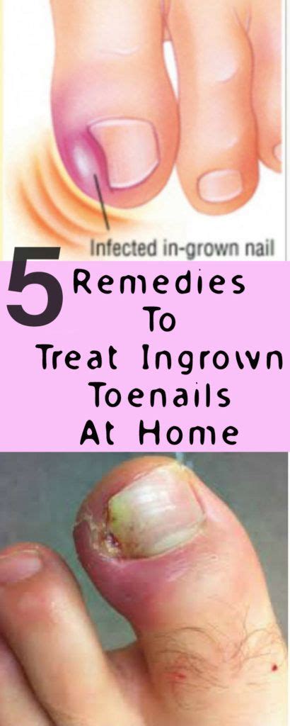 5 Remedies To Treat Ingrown Toenails At Home Lizy Style