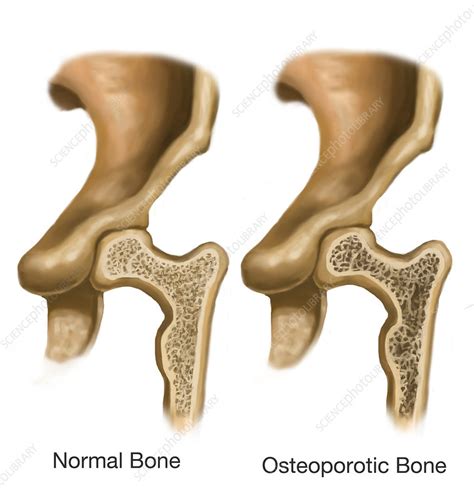 Osteoporotic And Normal Bone Illustration Stock Image C0277305