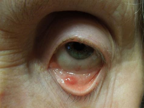 Moran Core Eyelid Masses