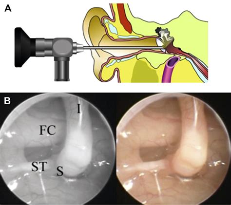 Transtympanic Endoscopy For Diagnosis Of Middle Ear Pathology