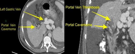 Computed Tomography Showing Signs Of Segmental Portal Hypertension In