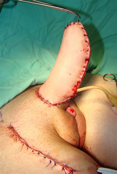 Vaginoplasty Before And After