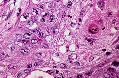 What Is Squamous Cell Carcinoma Southeast Radiation Oncology Group