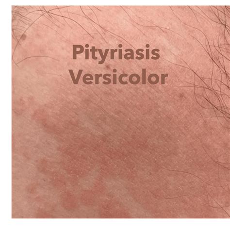 Summer Yeast Pityriasis Versicolor Symptoms Treatment And A Self