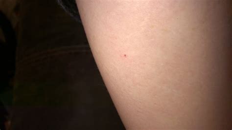 Little Red Frecklesblood Blisters On Belly And Theighs Babycenter